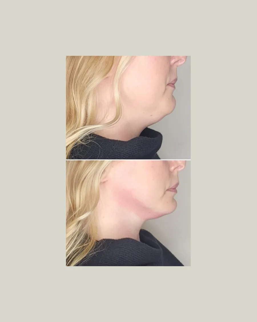 Before and after Cryo Double Chin, 5 sessions