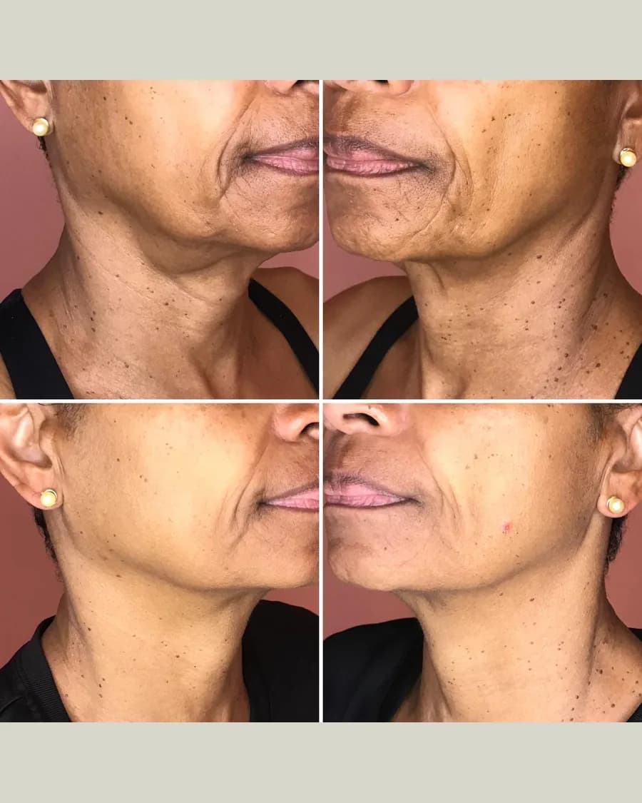 Before and after CryoFacelift, 4 sessions