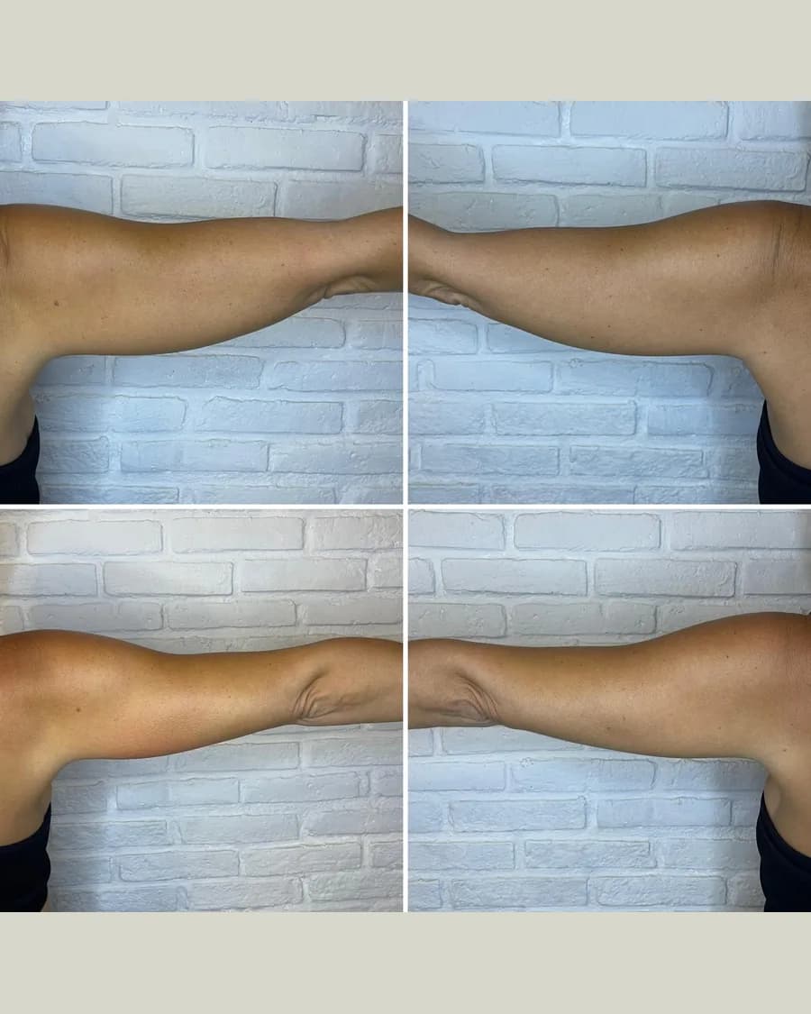 Before and after CryoSlimming · Arms, 1 session