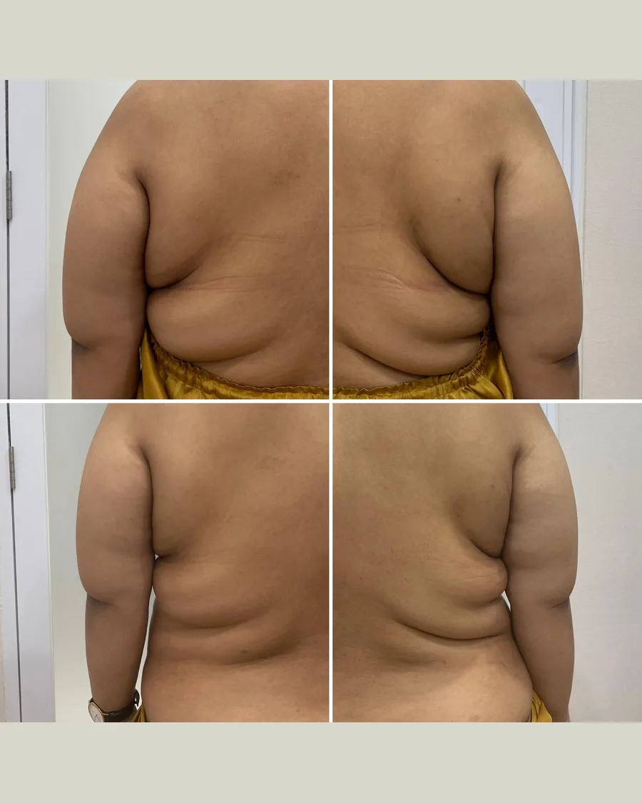 Before and after CryoSlimming · Back, 1 session