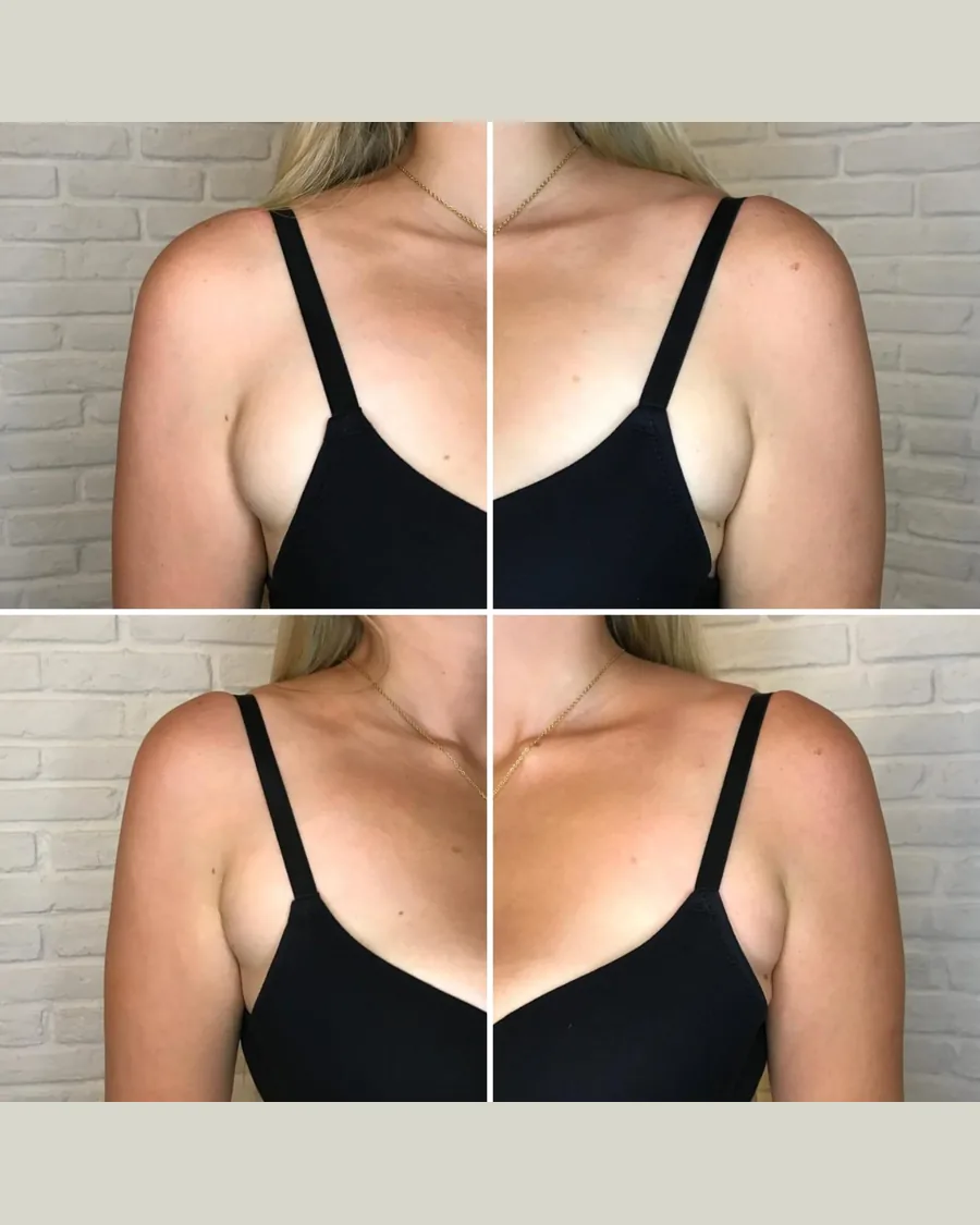 Before and after CryoSlimming · Bra line, 1 session
