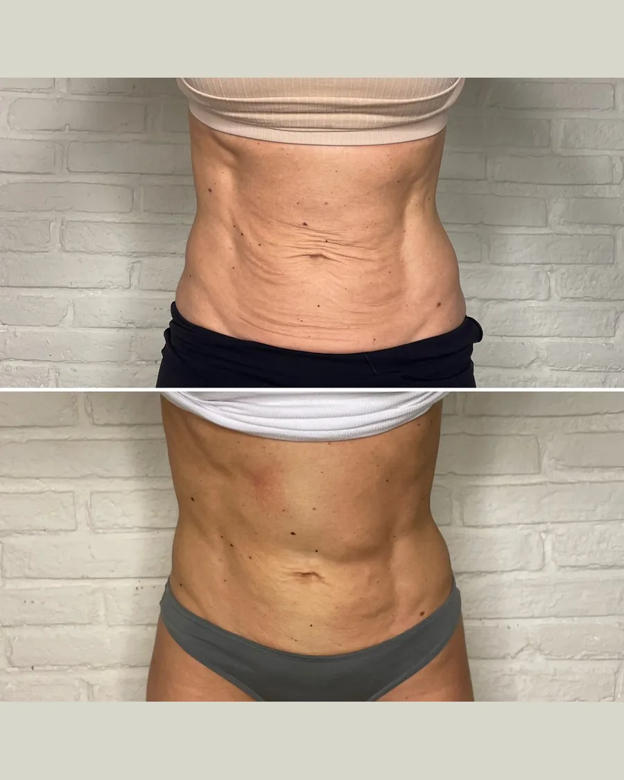 Before and after CryoToning · Abdomen, 4 sessions