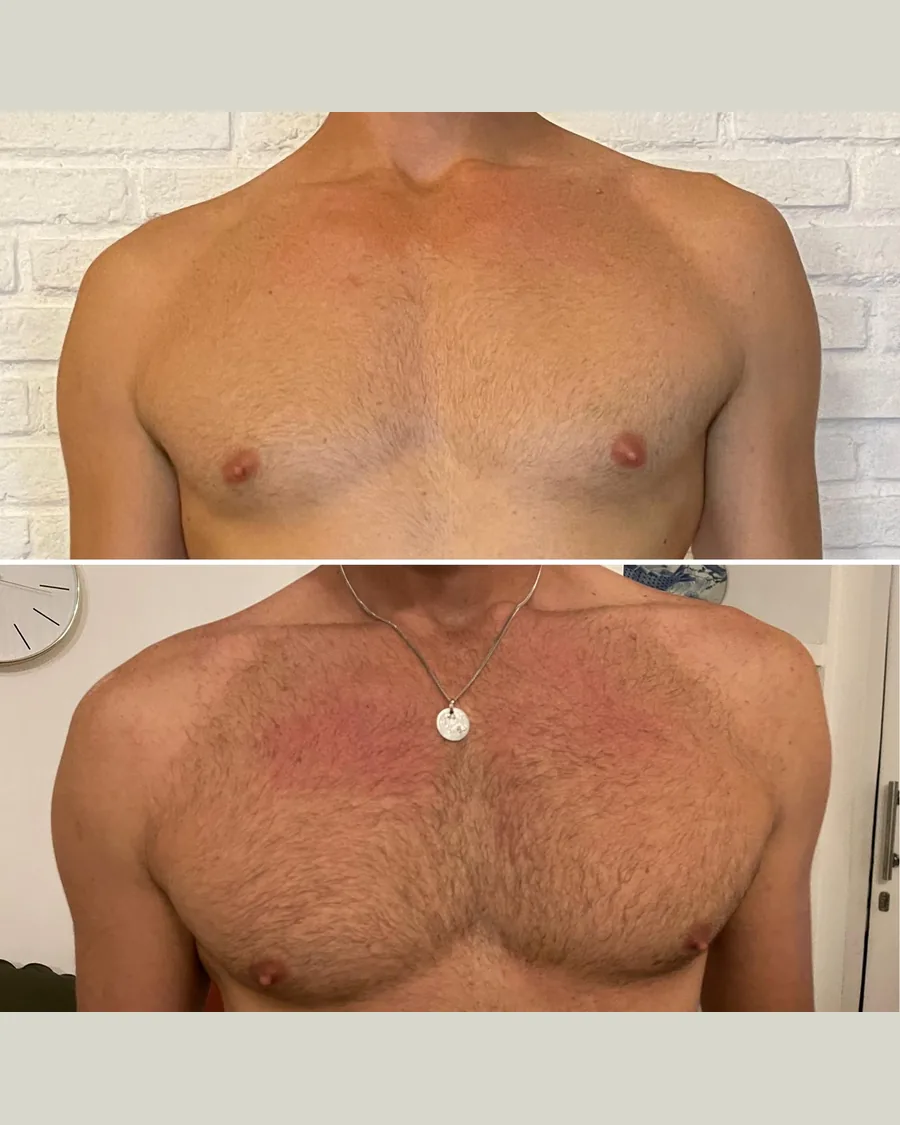 Before and after NMS · Muscle Growth, 5 sessions