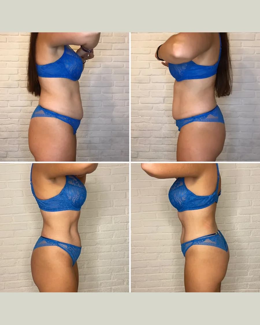 Before and after Slim & Sculpt, 3 sessions