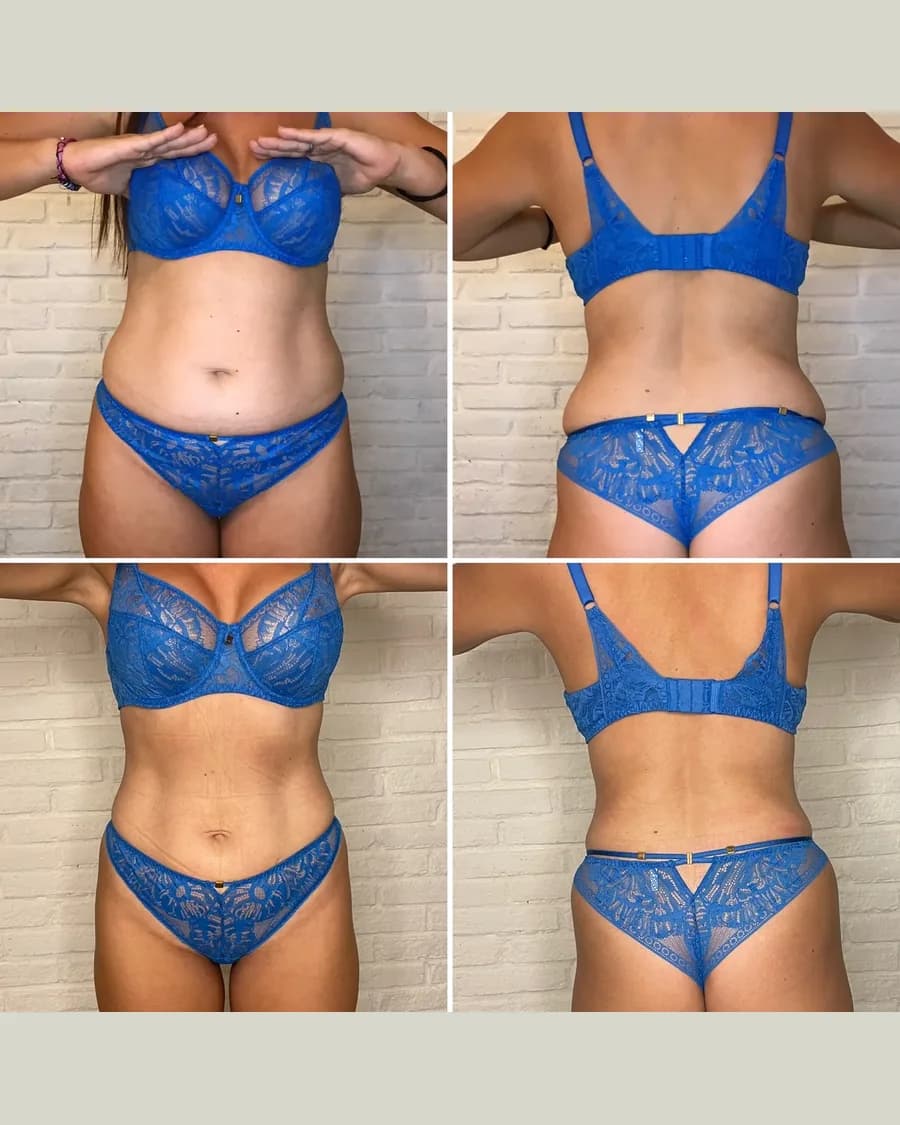 Before and after Slim & Sculpt, 3 sessions