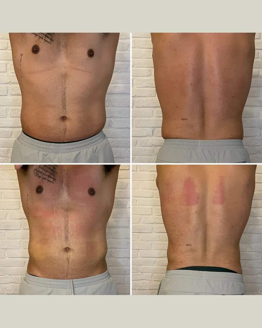 Before and after Slim & Sculpt, 1 session