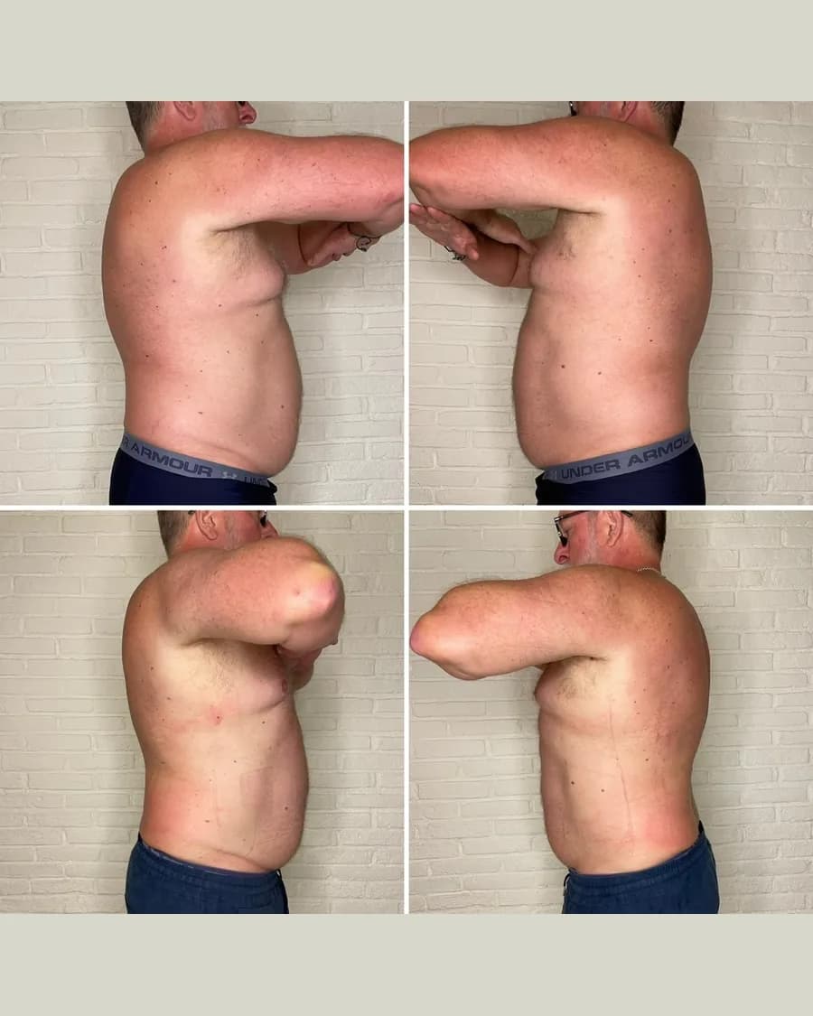 Before and after Slim & Sculpt, 1 session