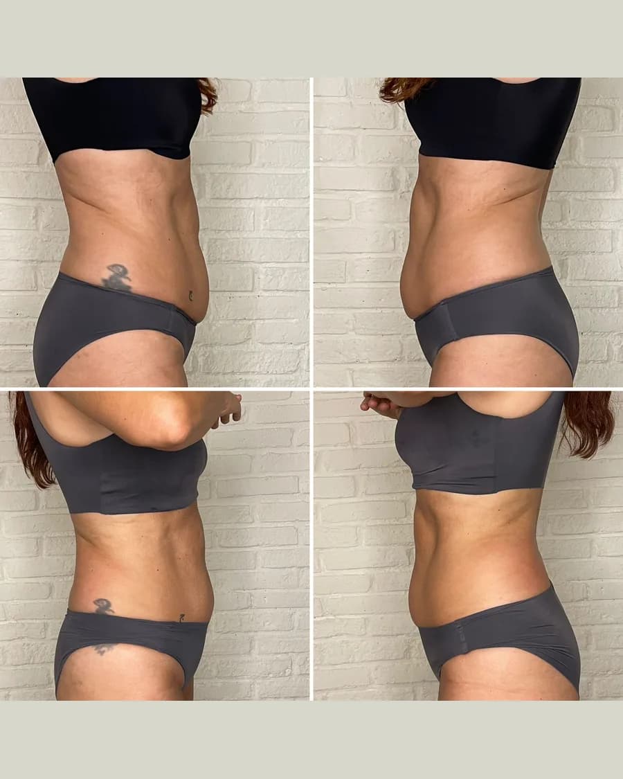 Before and after Slim & Sculpt, 1 session