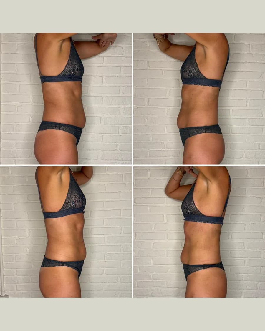 Before and after Slim & Sculpt, 1 session