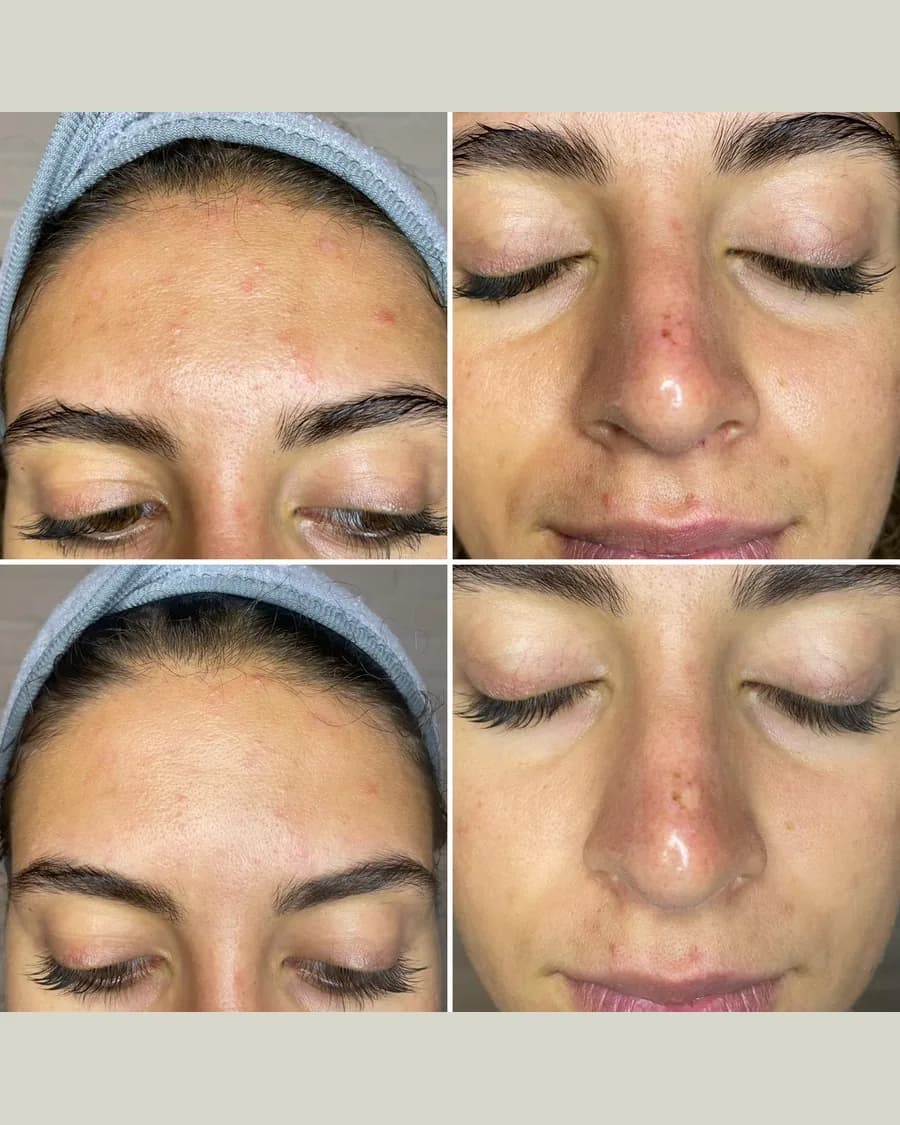 Before and after Ultra Plasma, 1 session